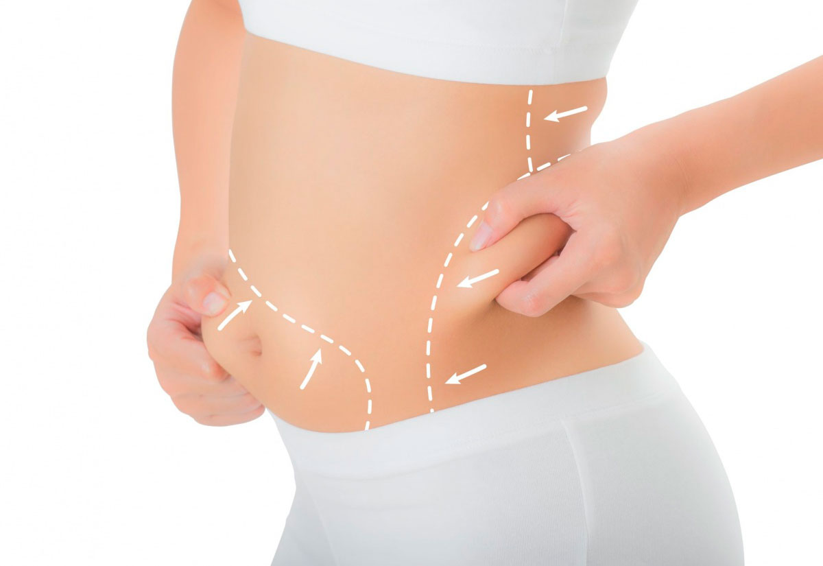 Liposuction | Fettabsaugen