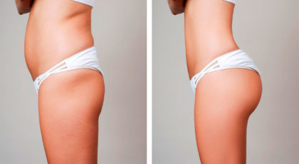 Fettabsaugen | Liposuction