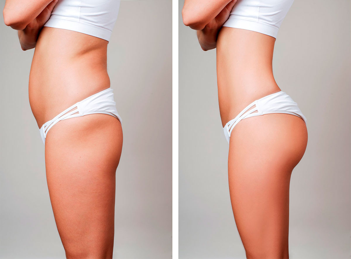 Fettabsaugen | Liposuction